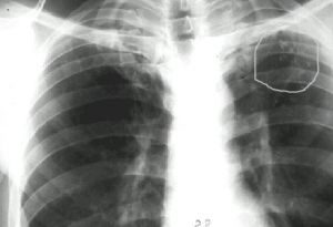 рентген-снимок лёгких больного туберкулёзом