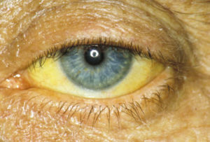 жёлтые склеры глаз при гепатите B