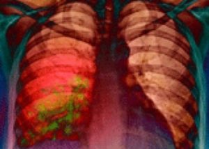 очаги инфекции в лёгких при пневмонии