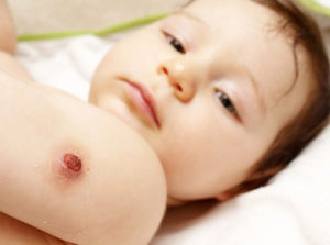 холодный абсцесс на руке у ребёнка после прививки