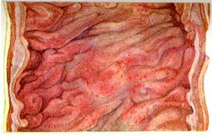 рисунок воспаления слизистой оболочки кишечника при дизентерии