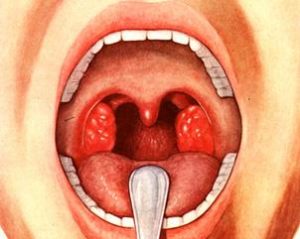 рисунок красного горла и воспалённых миндалин