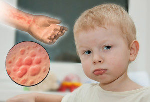 аллергические высыпания на коже у ребёнка