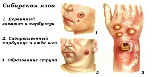 рисунок клинических проявлений сибирской язвы