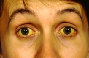 жёлтые склеры глаз у человека, больного лептоспирозом