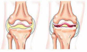 рисунок здорового сустава и поражённого артритом