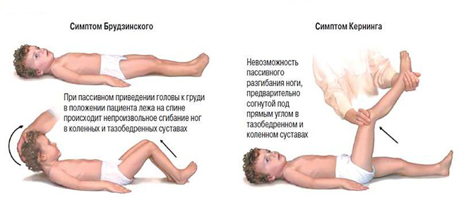 Рисунок симптомов Брудзинского и Кернига